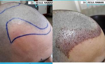 Hair restoration procedure before and after results