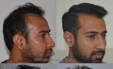 Hair transplantation surgery before and after images