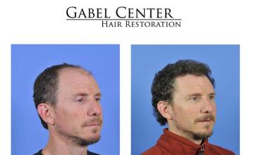 Right oblique view before and after hair transplant