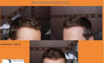 Hair transplant surgery before and after photos