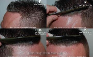 Postoperative hair transplant hairline photos