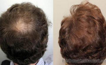 Back - Crown photos of before and after hair transplant