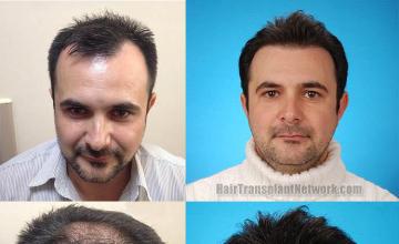 Front view - Before and after hair transplant surgery result images