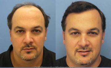 Front photos showing hair transplant surgery results