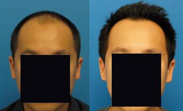 Hair restoration procedure before and after results