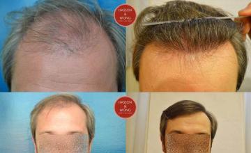 Hair transplantation surgery before and after pictures