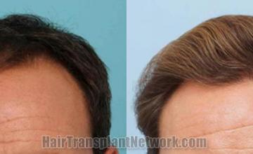 Hair restoration procedure before and after results