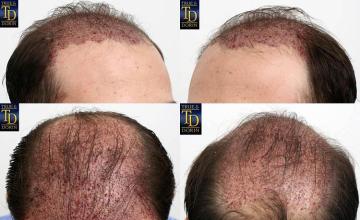 Hair restoration surgery immediate postoperative