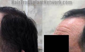 Hair transplantation surgery before and after pictures