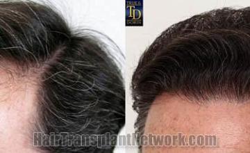 Hair transplantation surgery before and after pictures