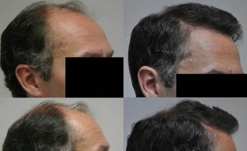 Hair restoration procedure before and after results