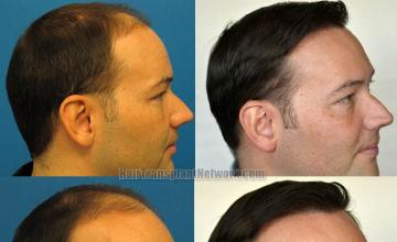 Hair transplantation surgery before and after images