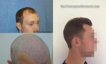 Hair restoration procedure before and after pictures