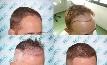 Hair transplantation surgery before and after photos