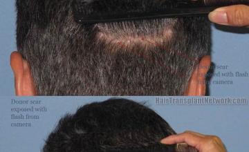 Hair restoration procedure before and after pictures