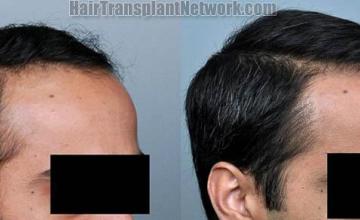 Hair restoration procedure before and after results