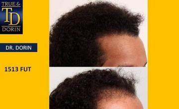 Hair restoration procedure before and after pictures