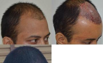 Hair transplantation surgery before and after photos