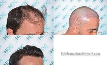 Hair transplantation surgery before and after photos