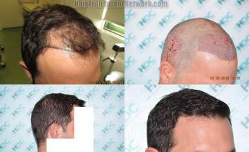 Hair restoration procedure before and after results