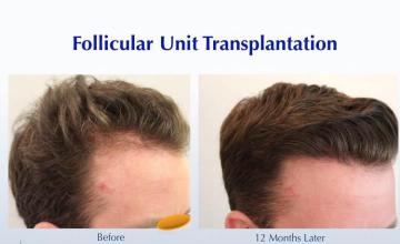 Hair transplantation surgery before and after images