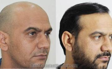 Hair transplantation procedure before and after results