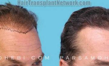 Hair transplantation surgery before and after images