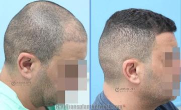 Hair transplantation procedure before and after results