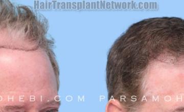 Hair restoration procedure after result images