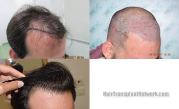 Hair transplantation procedure before and after results