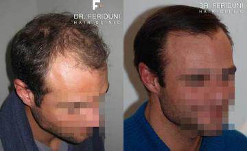 Hair transplantation surgery before and after images