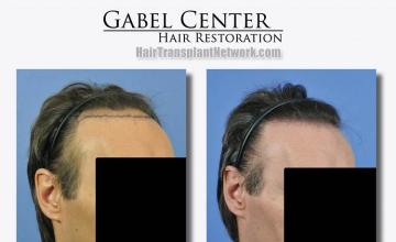 Hair transplantation surgery before and after pictures