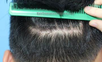 Hair replacement surgery before and after images