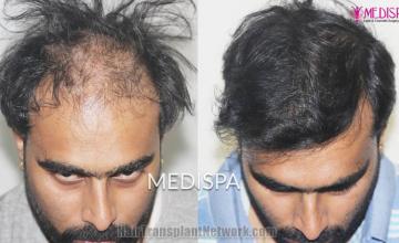 Hair restoration procedure before and after results