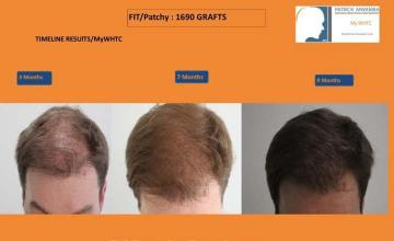 Hair transplantation surgery before and after photos