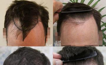 Before and after hair transplantation result photographs