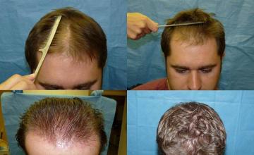 Hair restoration before and after photos