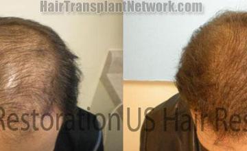 Hair restoration before and after photographs