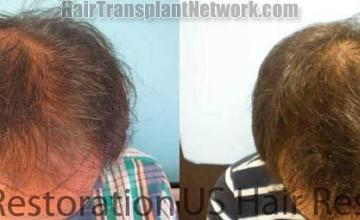 Top view before and after hair restoration results