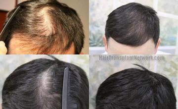 Before and after hair transplant procedure images