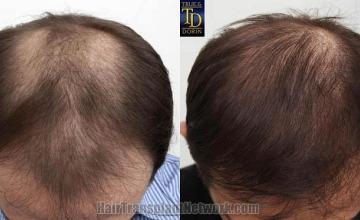 Before and after hair transplantation result photographs