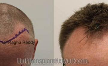 Hair restoration procedure before and after results