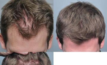 Hair transplantation surgery before and after photos