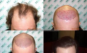 Hair restoration procedure before and after results