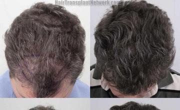 Hair transplantation surgery before and after photos