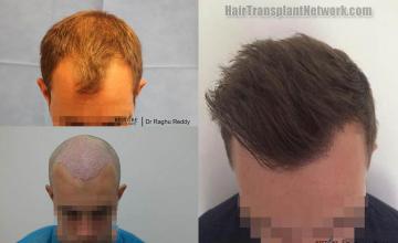 Hair transplantation surgery before and after pictures