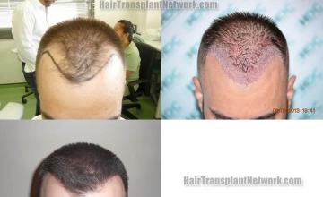 Hair transplantation surgery before and after photos