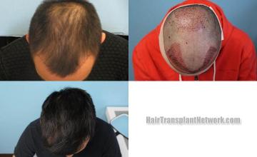 Top view before and after hair restoration results