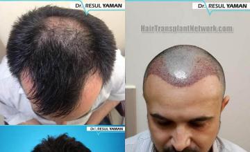 Top view - Before and after surgical hair replacement