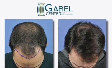 Hair restoration procedure before and after results